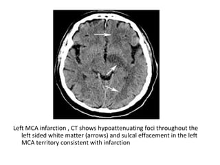Left MCA infarction , CT shows hypoattenuating foci throughout the
left sided white matter (arrows) and sulcal effacement in the left
MCA territory consistent with infarction
 