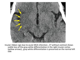 Insular ribbon sign due to acute MCA infarction , CT without contrast shows
subtle loss of the gray-white differentiation in the right insular cortex
(yellow arrows) , gray-white differentiation is preserved on the normal left
side
 