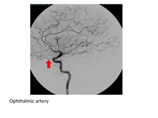 Ophthalmic artery
 