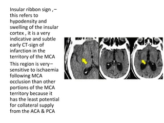 -Insular ribbon sign ,
this refers to
hypodensity and
swelling of the insular
cortex , it is a very
indicative and subtle
early CT-sign of
infarction in the
territory of the MCA
-This region is very
sensitive to ischaemia
following MCA
occlusion than other
portions of the MCA
territory because it
has the least potential
for collateral supply
from the ACA & PCA
 