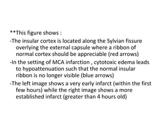 **This figure shows :
-The insular cortex is located along the Sylvian fissure
overlying the external capsule where a ribbon of
normal cortex should be appreciable (red arrows)
-In the setting of MCA infarction , cytotoxic edema leads
to hypoattenuation such that the normal insular
ribbon is no longer visible (blue arrows)
-The left image shows a very early infarct (within the first
few hours) while the right image shows a more
established infarct (greater than 4 hours old)
 