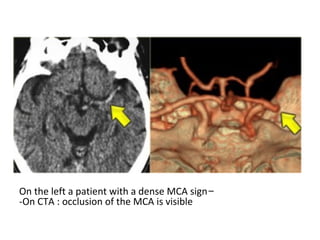 -On the left a patient with a dense MCA sign
-On CTA : occlusion of the MCA is visible
 