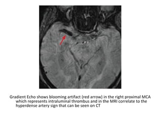Gradient Echo shows blooming artifact (red arrow) in the right proximal MCA
which represents intraluminal thrombus and in the MRI correlate to the
hyperdense artery sign that can be seen on CT
 