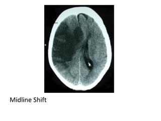 Midline Shift
 