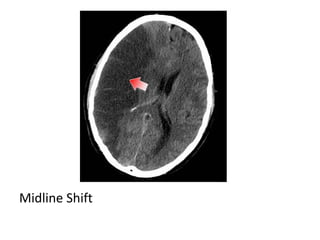 Midline Shift
 