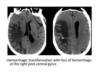 -Hemorrhagic transformation with foci of hemorrhage
at the right post central gyrus
 