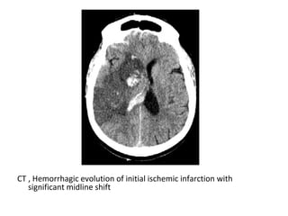 CT , Hemorrhagic evolution of initial ischemic infarction with
significant midline shift
 