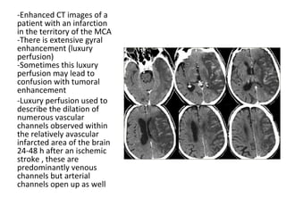 -Enhanced CT images of a
patient with an infarction
in the territory of the MCA
-There is extensive gyral
enhancement (luxury
perfusion)
-Sometimes this luxury
perfusion may lead to
confusion with tumoral
enhancement
-Luxury perfusion used to
describe the dilation of
numerous vascular
channels observed within
the relatively avascular
infarcted area of the brain
24-48 h after an ischemic
stroke , these are
predominantly venous
channels but arterial
channels open up as well
 