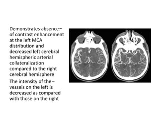 -Demonstrates absence
of contrast enhancement
at the left MCA
distribution and
decreased left cerebral
hemispheric arterial
collateralization
compared to the right
cerebral hemisphere
-The intensity of the
vessels on the left is
decreased as compared
with those on the right
 