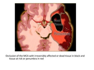 Occlusion of the MCA with irreversibly affected or dead tissue in black and
tissue at risk or penumbra in red
 