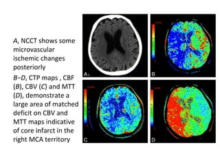A, NCCT shows some
microvascular
ischemic changes
posteriorly
B−D, CTP maps , CBF
(B), CBV (C) and MTT
(D), demonstrate a
large area of matched
deficit on CBV and
MTT maps indicative
of core infarct in the
right MCA territory
 