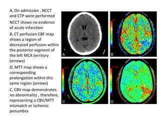 A, On admission , NCCT
and CTP were performed
NCCT shows no evidence
of acute infarction
B, CT perfusion CBF map
shows a region of
decreased perfusion within
the posterior segment of
the left MCA territory
(arrows)
D, MTT map shows a
corresponding
prolongation within this
same region (arrows)
C, CBV map demonstrates
no abnormality , therefore,
representing a CBV/MTT
mismatch or ischemic
penumbra
 