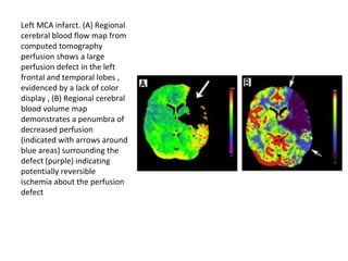 Left MCA infarct. (A) Regional
cerebral blood flow map from
computed tomography
perfusion shows a large
perfusion defect in the left
frontal and temporal lobes ,
evidenced by a lack of color
display , (B) Regional cerebral
blood volume map
demonstrates a penumbra of
decreased perfusion
(indicated with arrows around
blue areas) surrounding the
defect (purple) indicating
potentially reversible
ischemia about the perfusion
defect
 