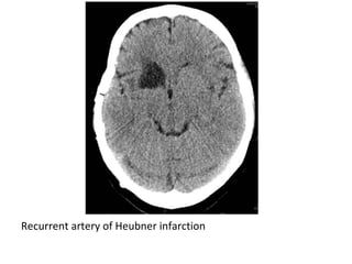 Recurrent artery of Heubner infarction
 