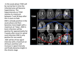 -In the acute phase T2WI will
be normal but in time the
infarcted area will become
hyperintense. The
hyperintensity on T2WI
reaches its maximum
between 7 and 30 days after
this it starts to fade
DWI is already positive in the
acute phase and then
becomes more bright with a
maximum at 7 days , DWI in
brain infarction will be
positive for approximately for
3 weeks after onset (in spinal
cord infarction DWI is only
positive for one week)
-ADC will be of low signal
intensity with a maximum at
24 hours and then will
increase in signal intensity
and finally becomes bright in
the chronic stage
 
