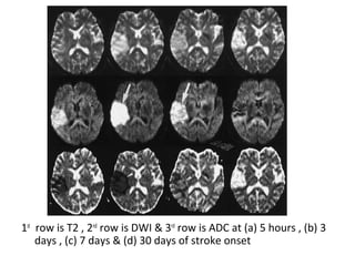 1st
row is T2 , 2nd
row is DWI & 3rd
row is ADC at (a) 5 hours , (b) 3
days , (c) 7 days & (d) 30 days of stroke onset
 