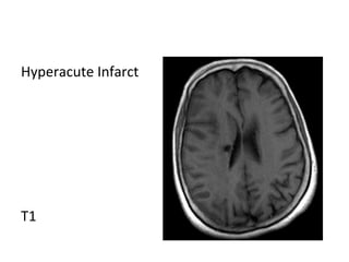 Hyperacute Infarct
T1
 