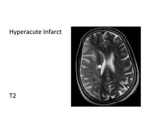 Hyperacute Infarct
T2
 