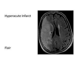 Hyperacute Infarct
Flair
 