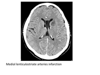 Medial lenticulostriate arteries infarction
 