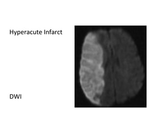 Hyperacute Infarct
DWI
 