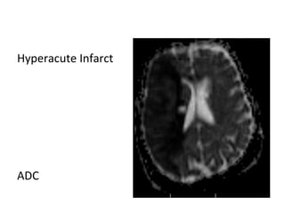 Hyperacute Infarct
ADC
 