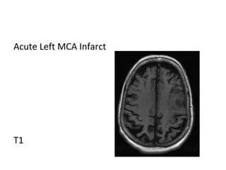 Acute Left MCA Infarct
T1
 