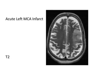 Acute Left MCA Infarct
T2
 