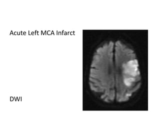 Acute Left MCA Infarct
DWI
 