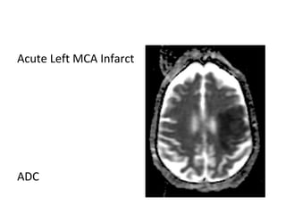 Acute Left MCA Infarct
ADC
 