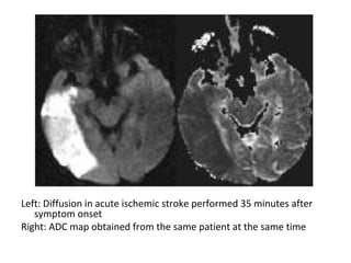 Left: Diffusion in acute ischemic stroke performed 35 minutes after
symptom onset
Right: ADC map obtained from the same patient at the same time
 