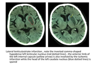 Lateral lenticulostriate infarction , note the inverted comma-shaped
hypodense left lenticular nucleus (red dotted lines) , the anterior limb of
the left internal capsule (yellow arrow) is also involved by the ischemic
infarction while the head of the left caudate nucleus (blue dotted lines) is
spared
 