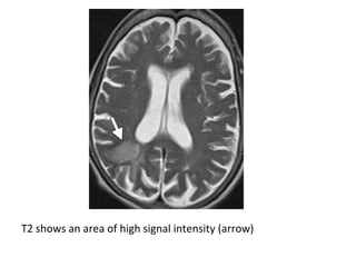 T2 shows an area of high signal intensity (arrow)
 