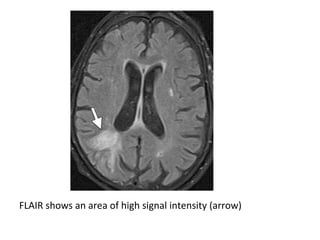 FLAIR shows an area of high signal intensity (arrow)
 