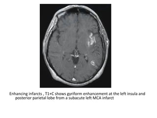 Enhancing infarcts , T1+C shows gyriform enhancement at the left insula and
posterior parietal lobe from a subacute left MCA infarct
 