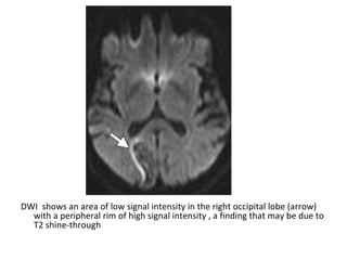 DWI shows an area of low signal intensity in the right occipital lobe (arrow)
with a peripheral rim of high signal intensity , a finding that may be due to
T2 shine-through
 