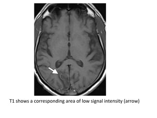 T1 shows a corresponding area of low signal intensity (arrow)
 