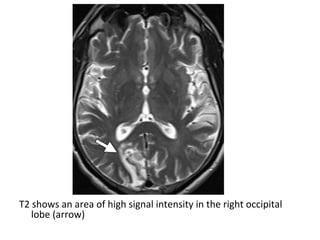 T2 shows an area of high signal intensity in the right occipital
lobe (arrow)
 
