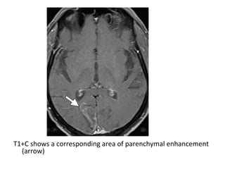 T1+C shows a corresponding area of parenchymal enhancement
(arrow)
 