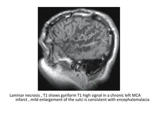 Laminar necrosis , T1 shows gyriform T1 high signal in a chronic left MCA
infarct , mild enlargement of the sulci is consistent with encephalomalacia
 