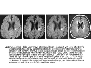 A : Diffusion with b = 1000 s/mm2
shows a high signal lesion , consistent with acute infarct in the
left corona radiata and a low signal area in the right periventricular white matter (arrow),
consistent with a chronic infarct, a second low signal lesion is seen anterior to the high-signal
area in the left subcortical white matter, B : Diffusion at b = 2500 s/mm2 shows increased
contrast of the high signal and two low-signal lesions, C : Diffusion at b = 3000 s/mm2 also
shows the high and low signal areas more conspicuously than at b = 1000, D : FLAIR image
demonstrating the encephalomalacia and reactive gliosis associated with the two chronic
strokes seen as low signal lesions on a diffusion-weighted image, and increased signal in the
lesion seen as high signal on a diffusion-weighted image
 