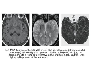 Left MCA thrombus , the left MCA shows high signal from an intraluminal clot
on FLAIR (a) but low signal on gradient recalled echo (GRE) T2* (b) , this
corresponds to a filling defect (arrow) on CT angiogram (c) , asubtle FLAIR
high signal is present at the left insula
 