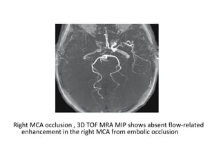 Right MCA occlusion , 3D TOF MRA MIP shows absent flow-related
enhancement in the right MCA from embolic occlusion
 