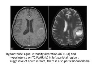 Hypointense signal intensity alteration on T1 (a) and
hyperintense on T2 FLAIR (b) in left parietal region ,
suggestive of acute infarct , there is also perilesional edema
 