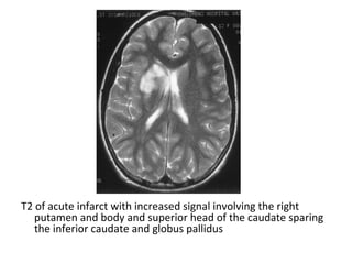 T2 of acute infarct with increased signal involving the right
putamen and body and superior head of the caudate sparing
the inferior caudate and globus pallidus
 