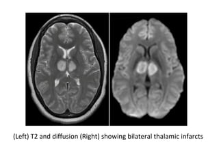 (Left) T2 and diffusion (Right) showing bilateral thalamic infarcts
 