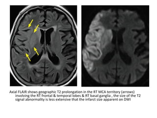 Axial FLAIR shows geographic T2 prolongation in the RT MCA territory (arrows)
involving the RT frontal & temporal lobes & RT basal ganglia , the size of the T2
signal abnormality is less extensive that the infarct size apparent on DWI
 