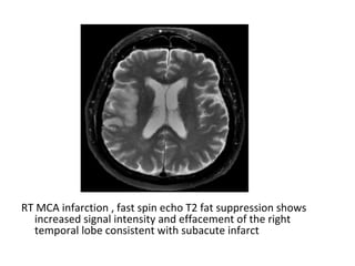 RT MCA infarction , fast spin echo T2 fat suppression shows
increased signal intensity and effacement of the right
temporal lobe consistent with subacute infarct
 