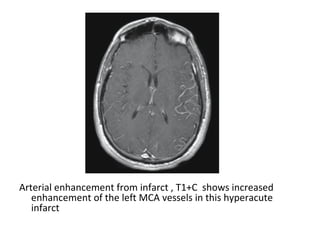 Arterial enhancement from infarct , T1+C shows increased
enhancement of the left MCA vessels in this hyperacute
infarct
 