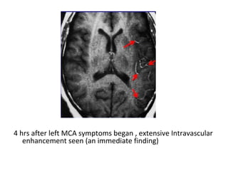 4 hrs after left MCA symptoms began , extensive Intravascular
enhancement seen (an immediate finding)
 